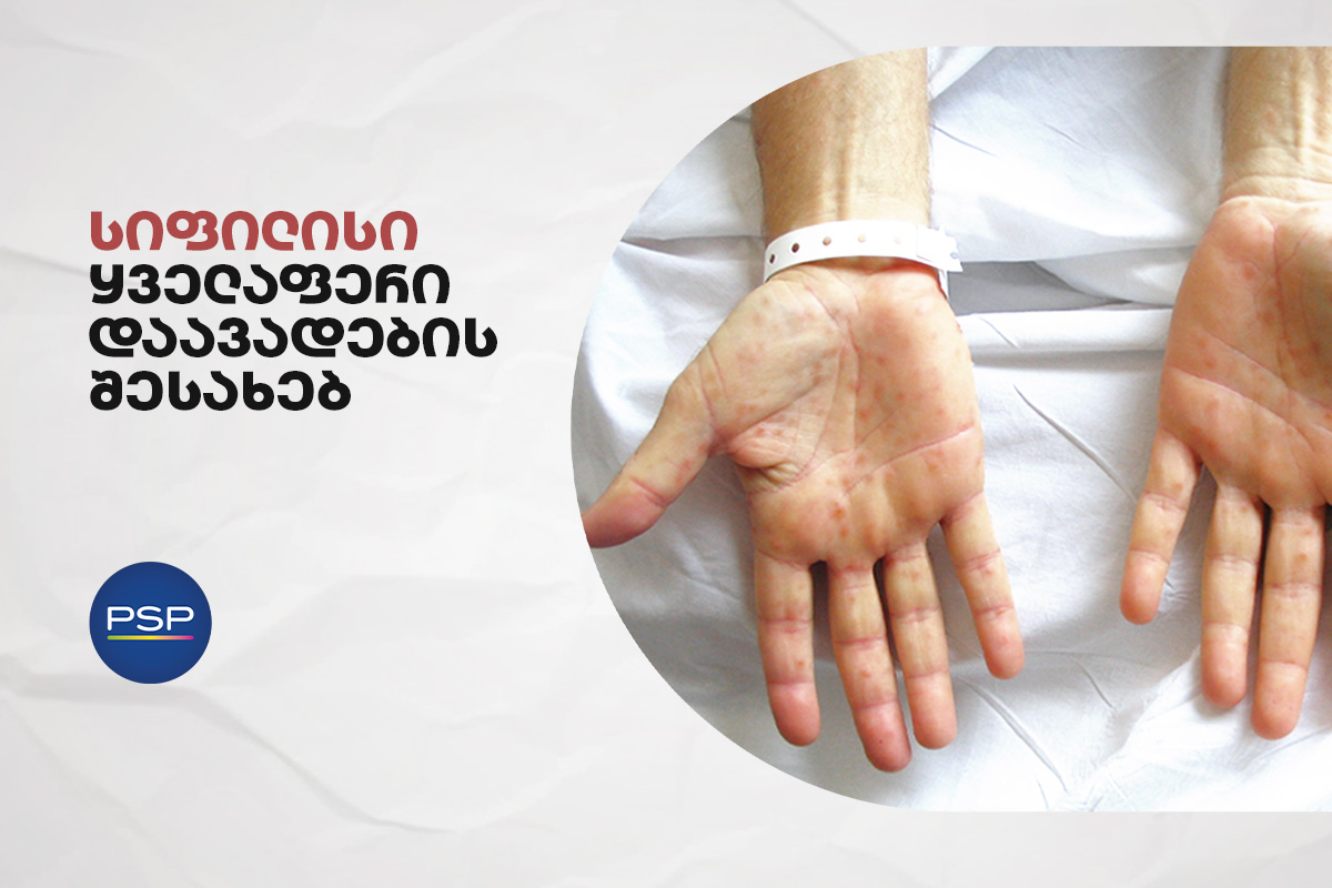 სიფილისი - ყველაფერი ამ დაავადების შესახებ