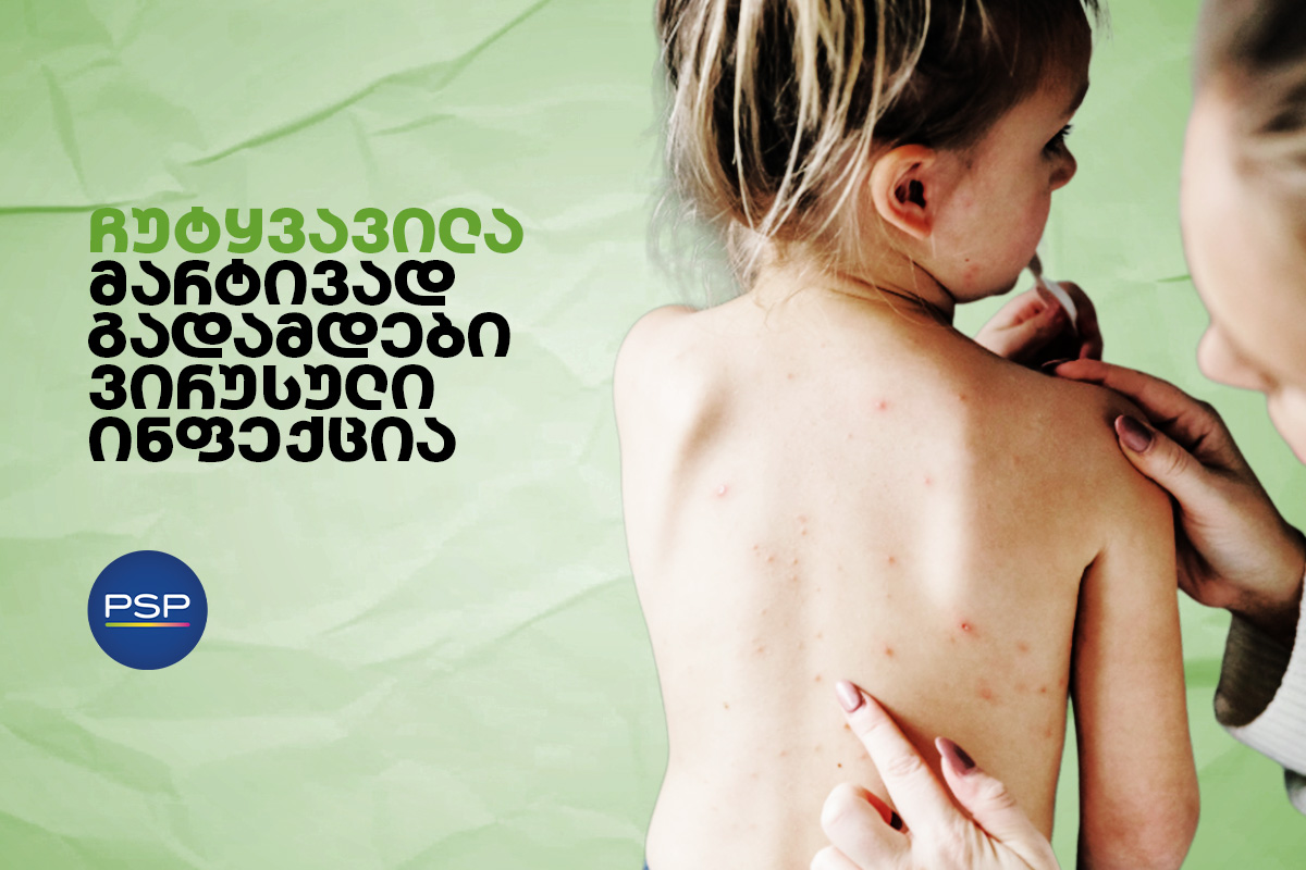 ჩუტყვავილა - მარტივად გადამდები ვირუსული ინფექცია