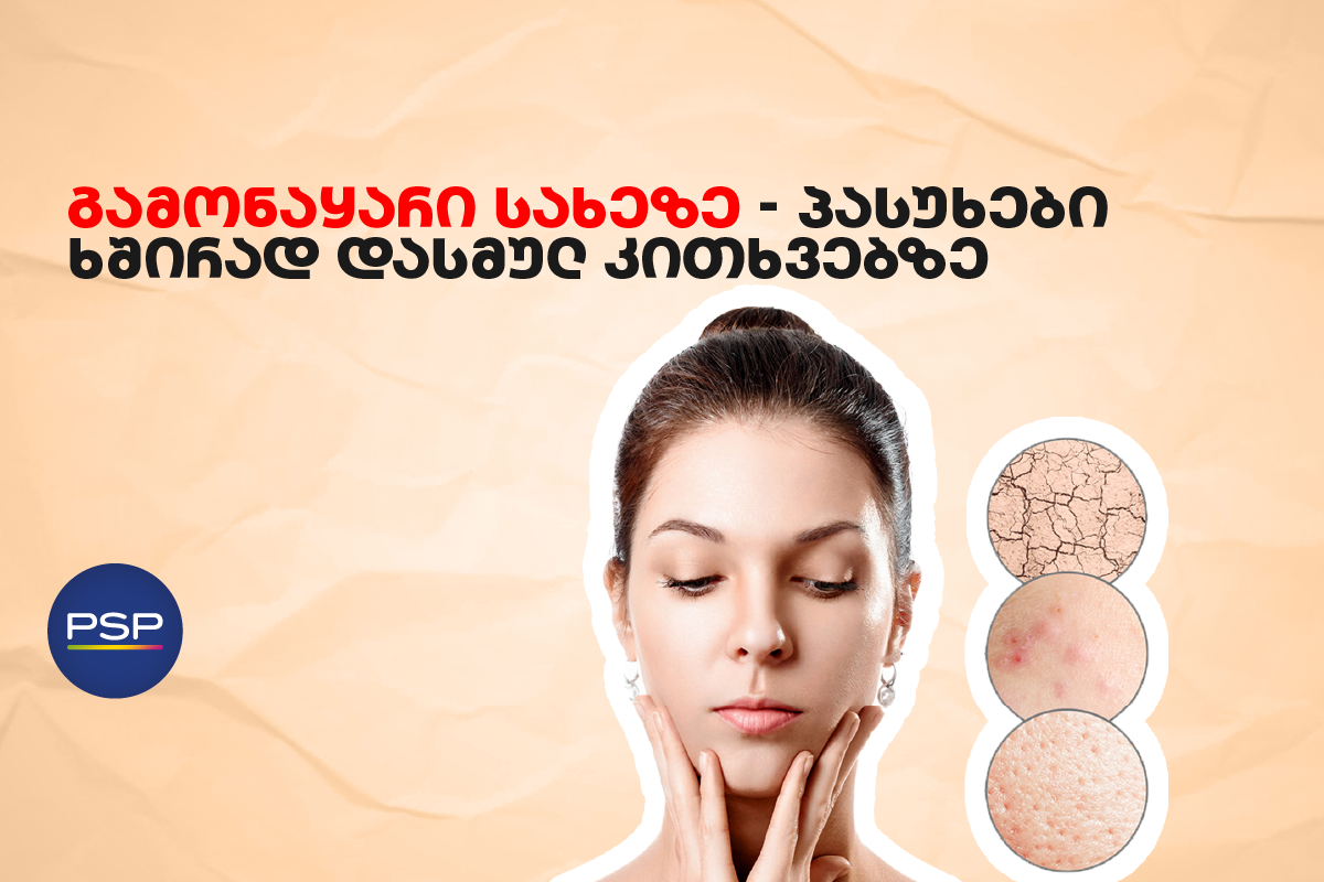 გამონაყარი სახეზე — პასუხები ხშირად დასმულ კითხვებზე 