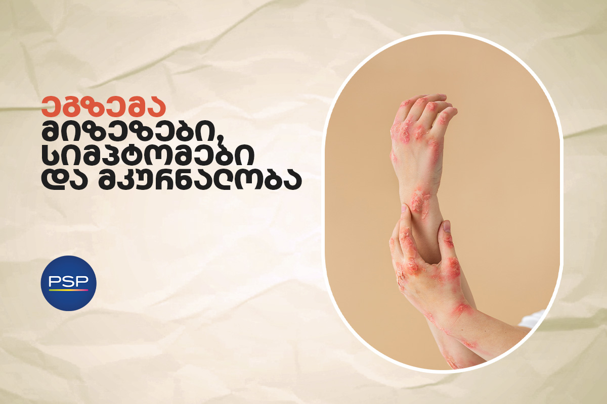 ეგზემა - მიზეზები, სიმპტომები და მკურნალობა