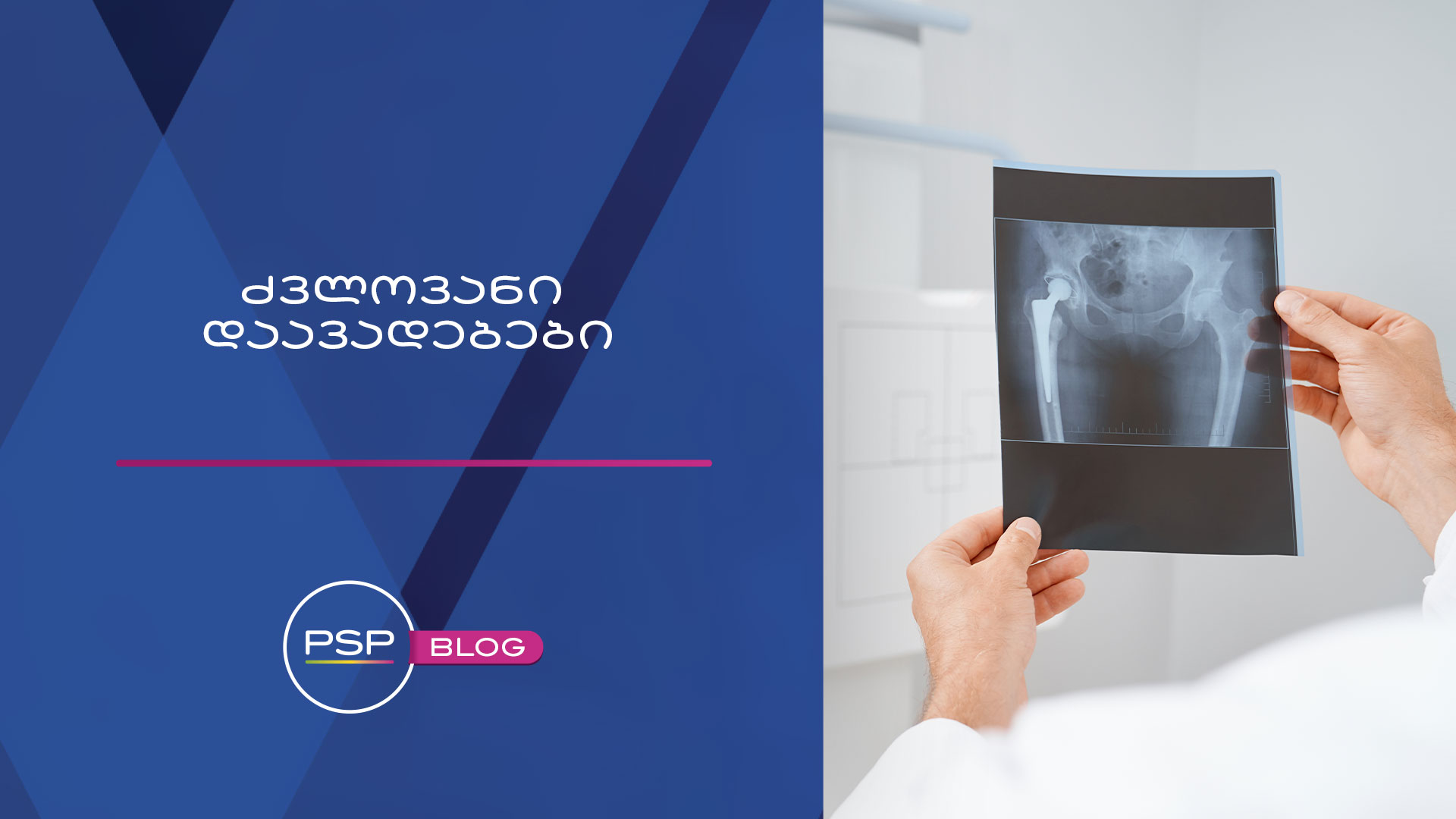 მოკლედ ძვლოვანი დაავადებების შესახებ 