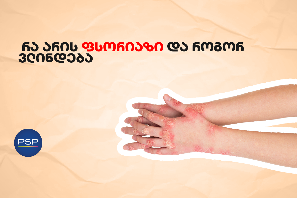  რა არის ფსორიაზი და როგორ ვლინდება 