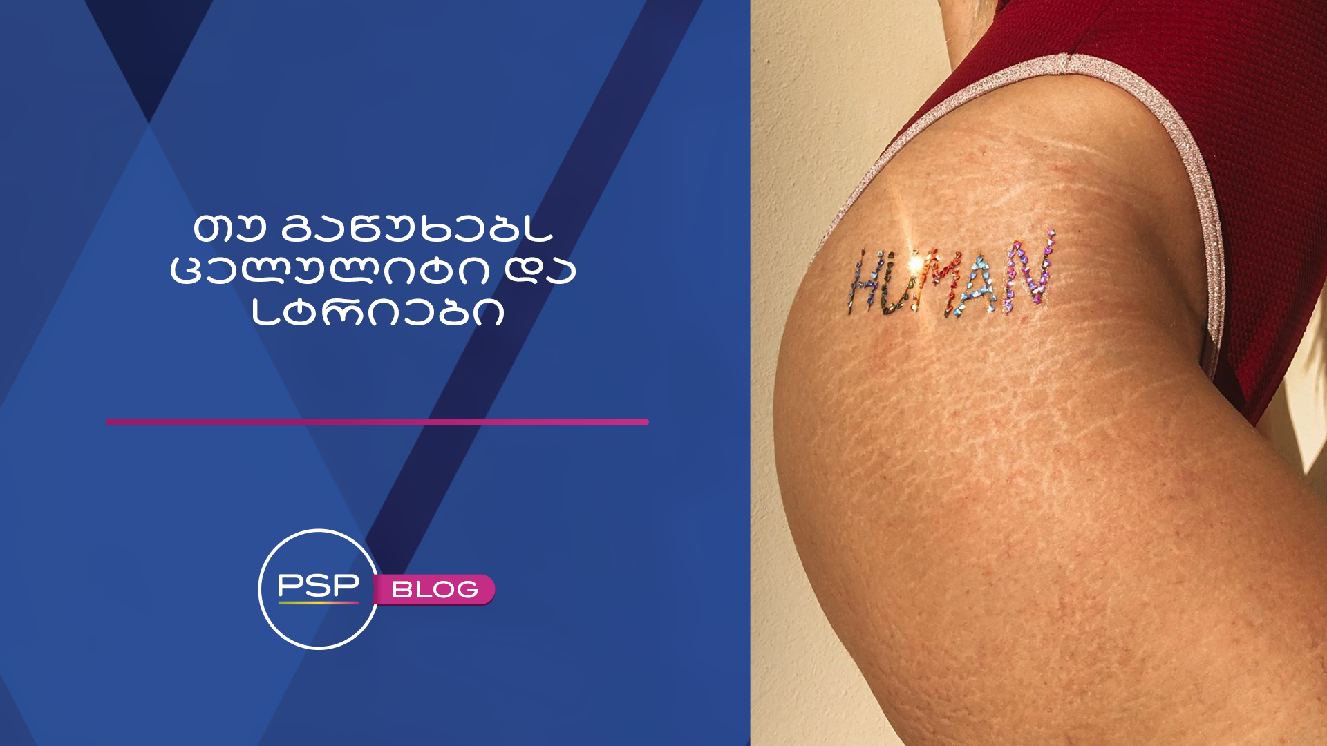 თუ გაწუხებთ ცელულიტი და სტრიები 