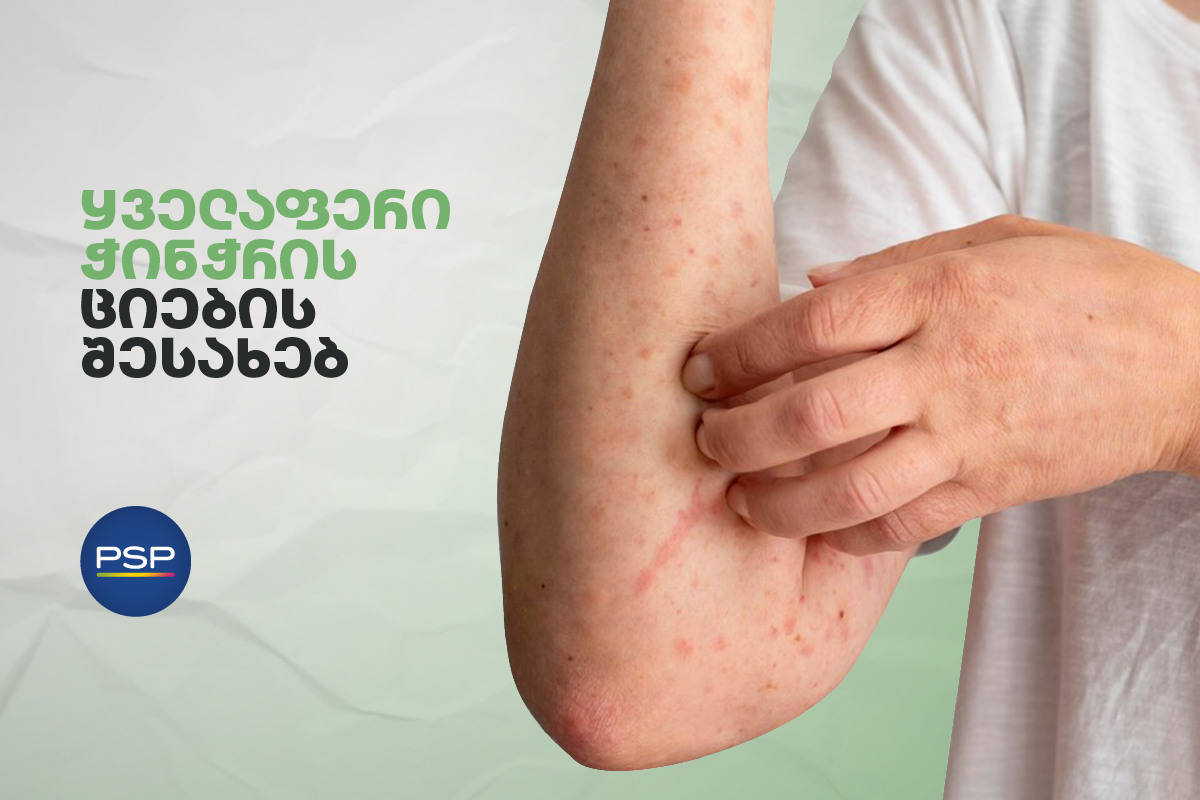 ყველაფერი ჭინჭრის ციების შესახებ