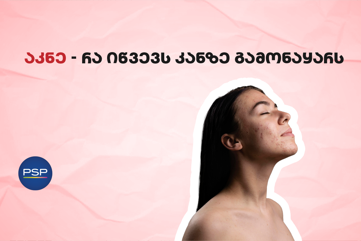 აკნე — რა იწვევს კანზე გამონაყარს 