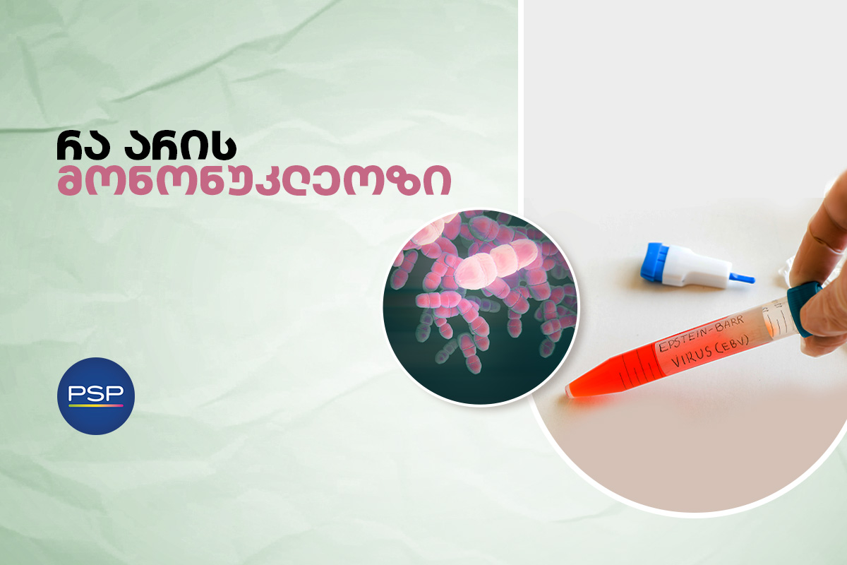რა არის მონონუკლეოზი 