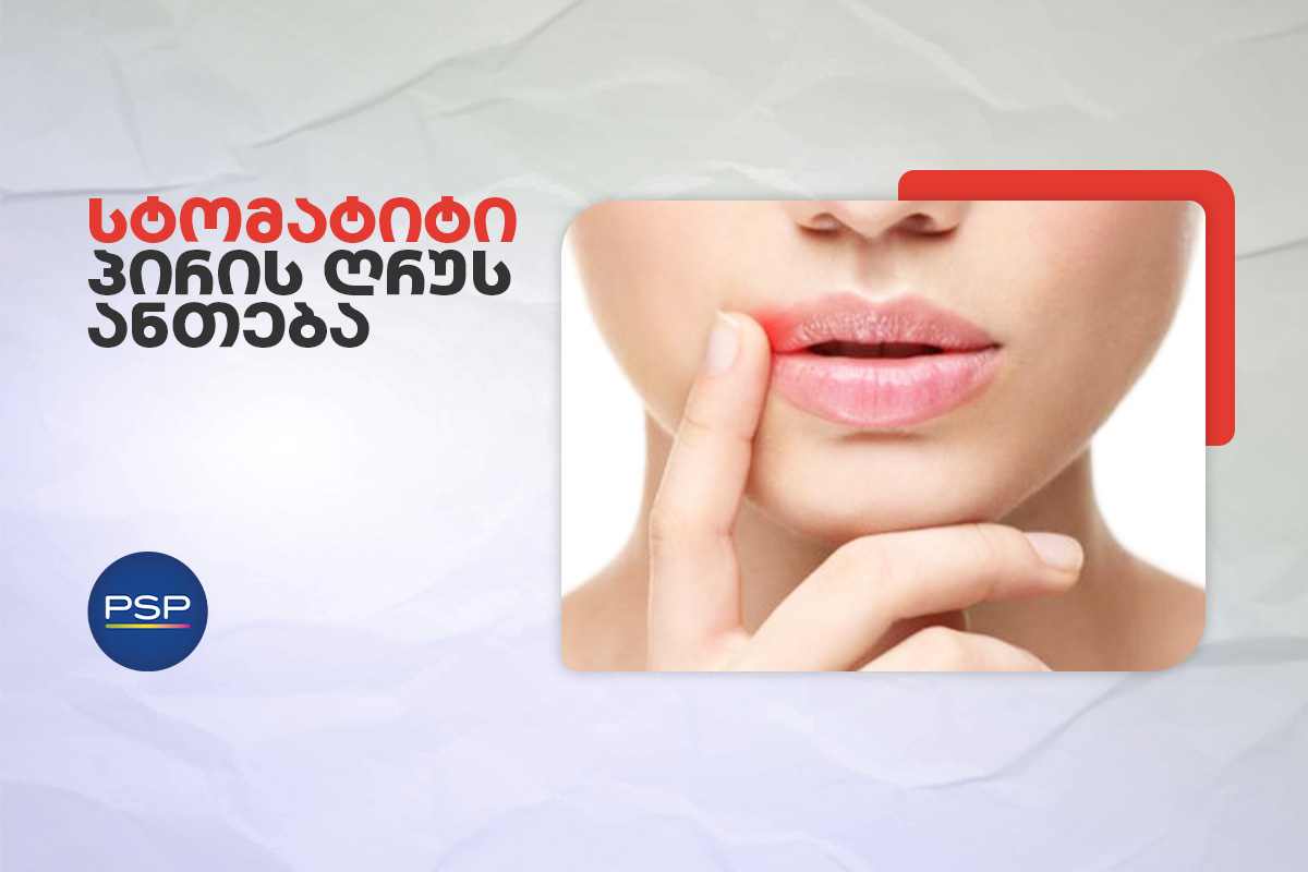სტომატიტი - პირის ღრუს ანთება