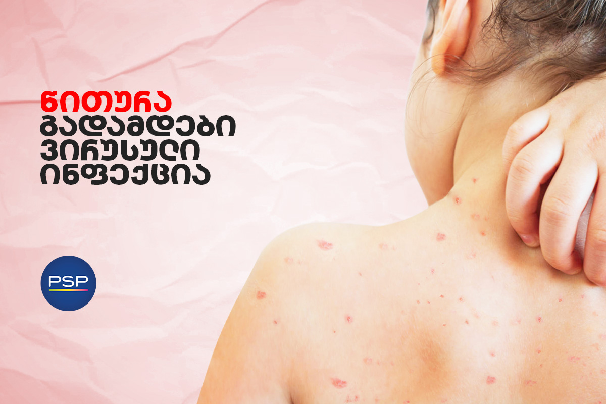 წითურა - გადამდები ვირუსული ინფექცია