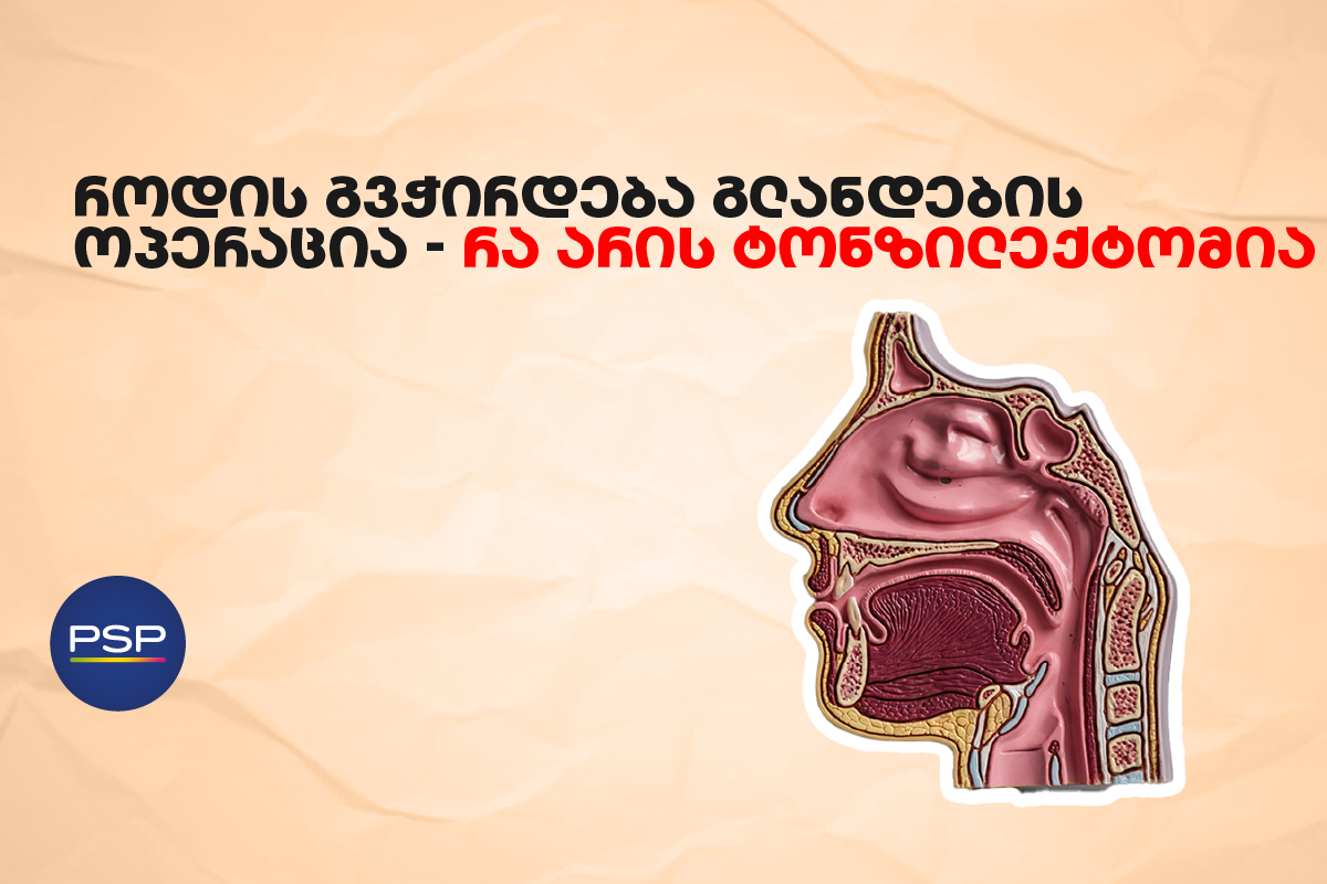 როდის გვჭირდება გლანდების ოპერაცია — რა არის ტონზილექტომია